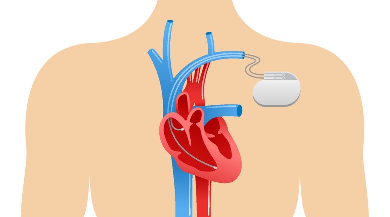 How does a pacemaker operate?