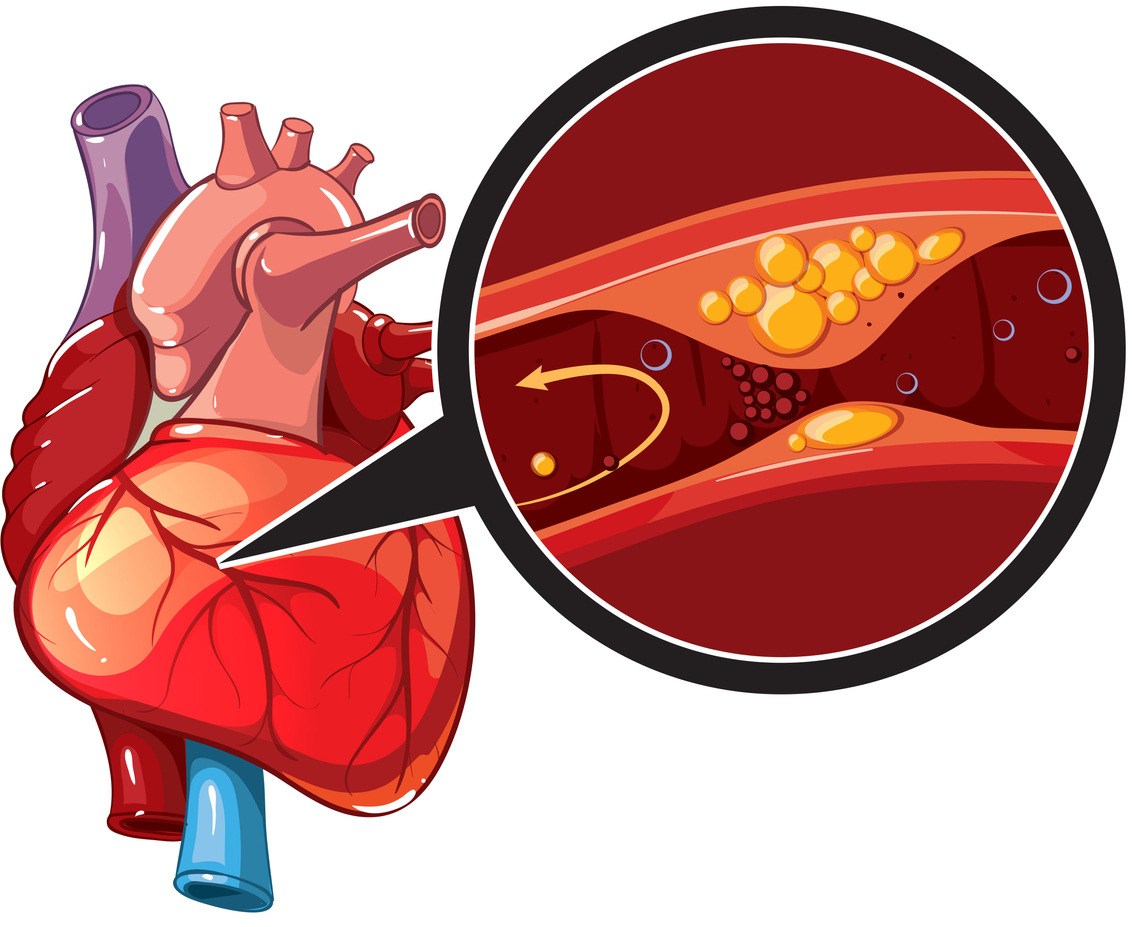 Coronary Heart Disease Treatment in Jaipur