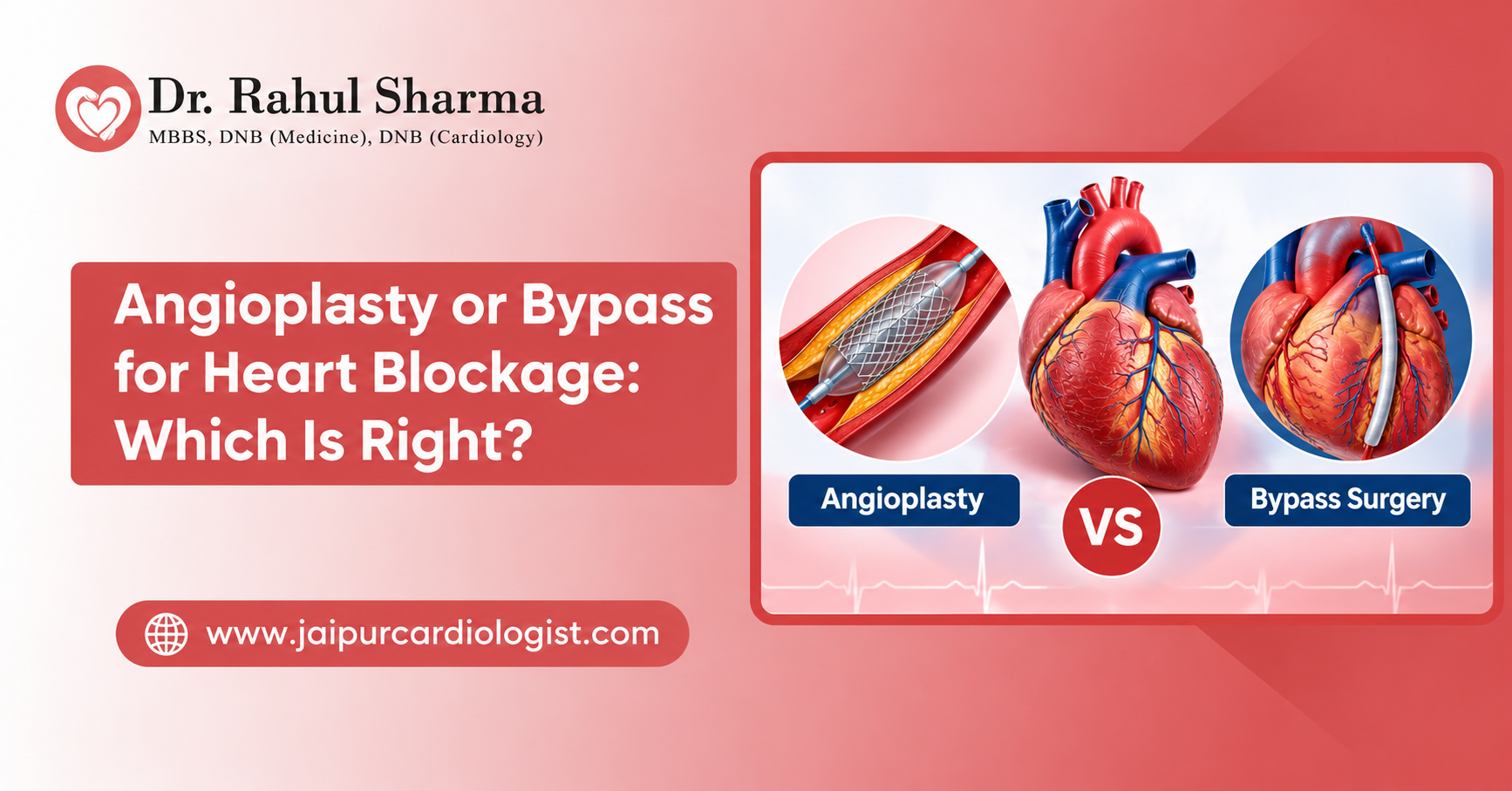 Angioplasty or Bypass for Heart Blockage: Which Is Right?